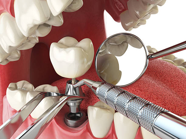 Best Emergency Dentist for Lost Fillings or Crowns in Sheridan, IL